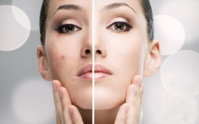 Consejos para tratar el acné en la cara
