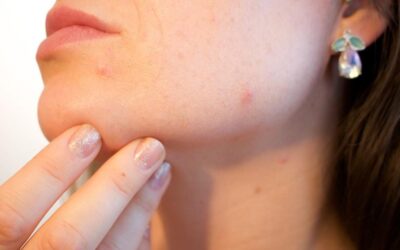 10 cosas que no sabías sobre el acné