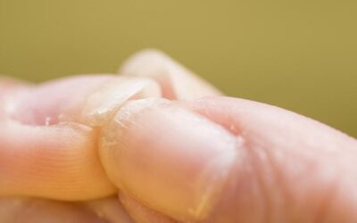 ¿Por qué aparecen las estrías en las uñas?