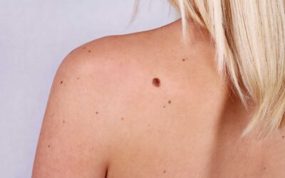 El melanoma, la primera causa de muerte dermatológica
