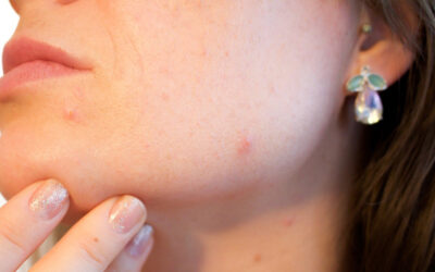 ¿Cómo tratar el acné y sus cicatrices?
