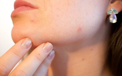 ¿Qué es y cómo tratar el acné de la mujer adulta?