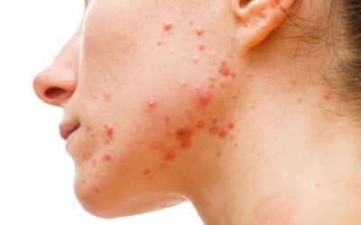¿Qué causa realmente el acné?