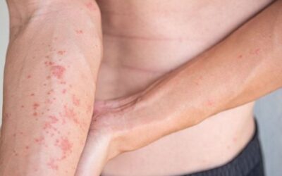La prevalencia de la dermatitis contacto