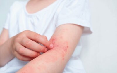 Eritemas y alergias cutáneas